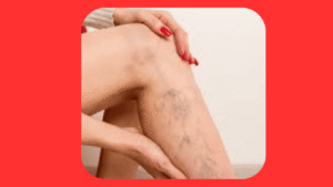 Varizes e Dor nas Pernas: Por Que Acontece e Quando se Agrava