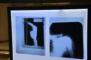 Dor na Escápula: O Que Pode Ser? Causas, Sintomas e Quando Se Preocupar