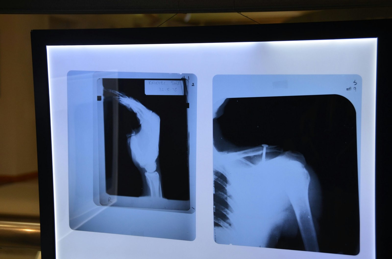 Dor na Escápula: O Que Pode Ser? Causas, Sintomas e Quando Se Preocupar